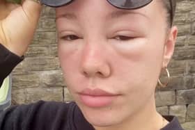 A Stockport woman’s eyes swelled over two days after she experienced sun poisoning.