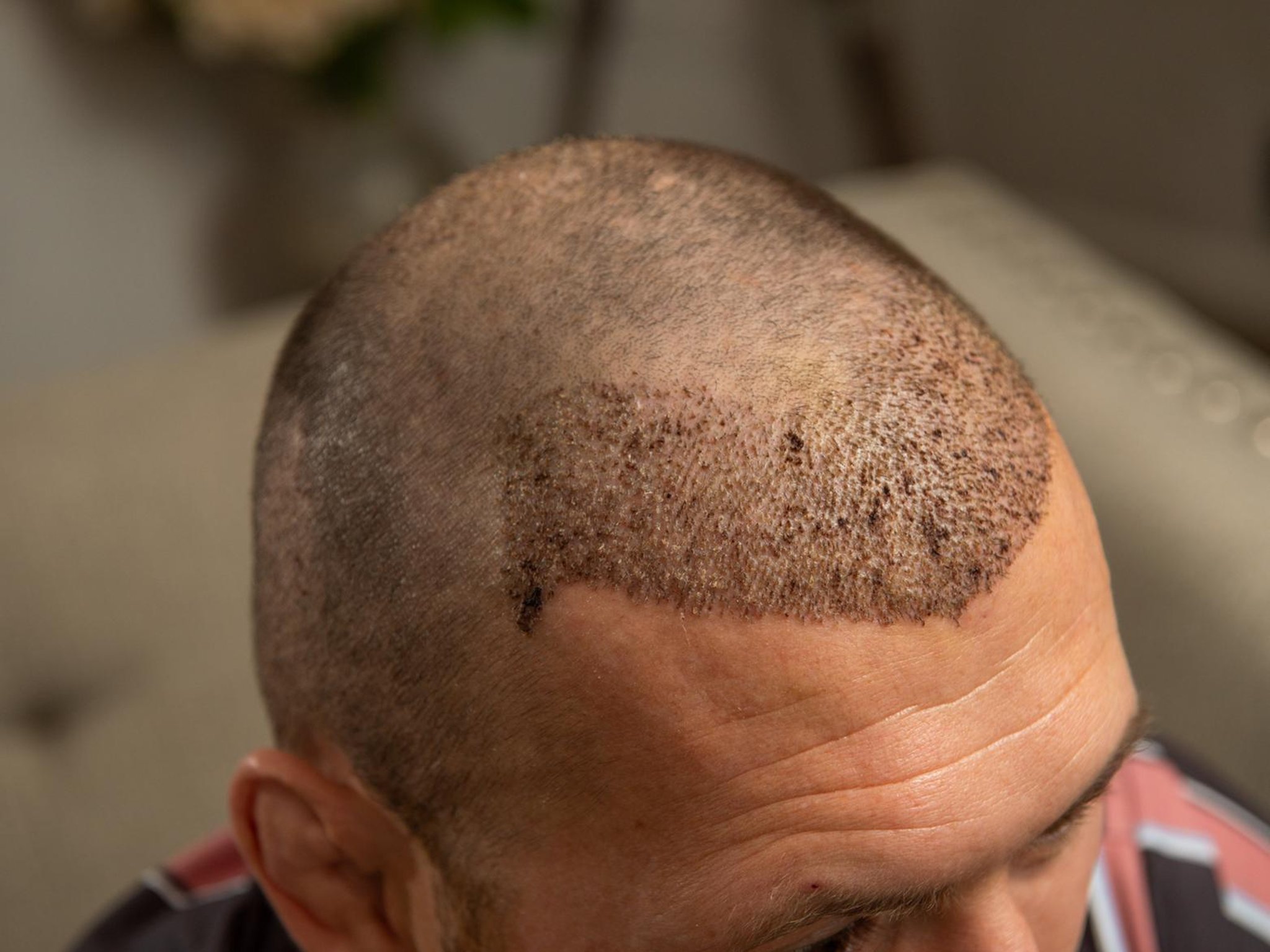 FUE Hair Transplant Cost Turkey, Best FUE in Turkey, FUE Transplant Turkey