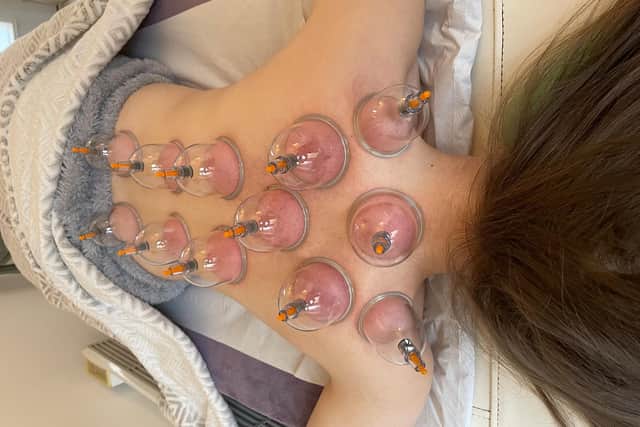 Hijama (cupping) is a relaxing and pain-free treatment that helps in relieving pain and illness.