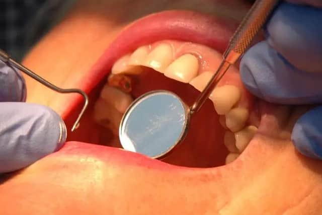 Dozens of children in Kirklees had decaying teeth removed in hospital during the first year of the coronavirus pandemic, new figures show.