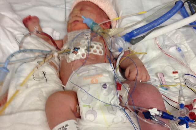 Martha was given life-saving open heart surgery when she was just six days old