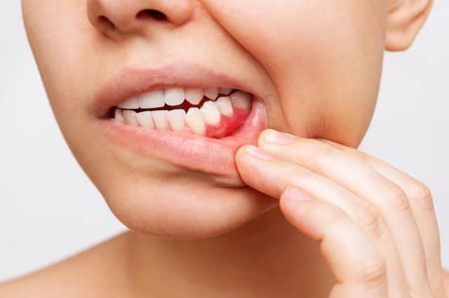 The commonest sign that it is present is soreness in the gums and bleeding when brushing the teeth. Photo: AdobeStock