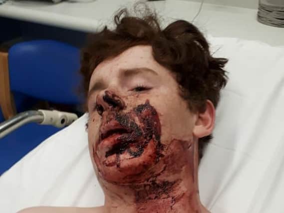 Mackenzie Cooper, 13, is in hospital following a hair-raising fall.